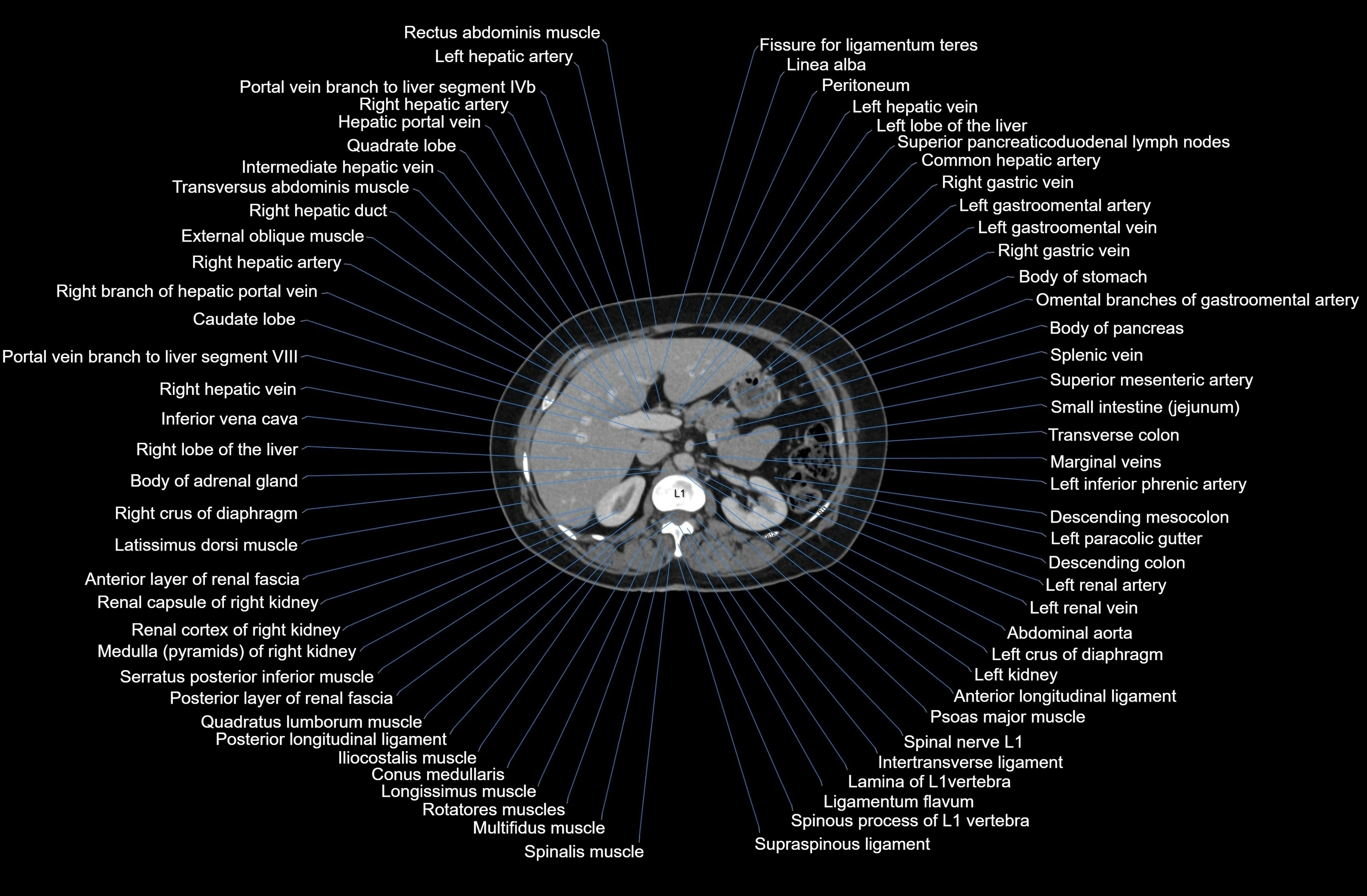 CT Abdomen axial cross sectional anatomy labelled radiology image-00028.webp